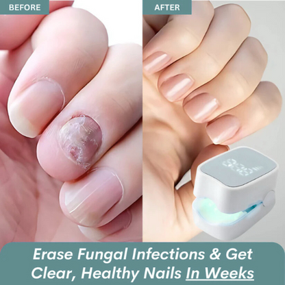 Mavriy™ - Nail Fungus Laser Device